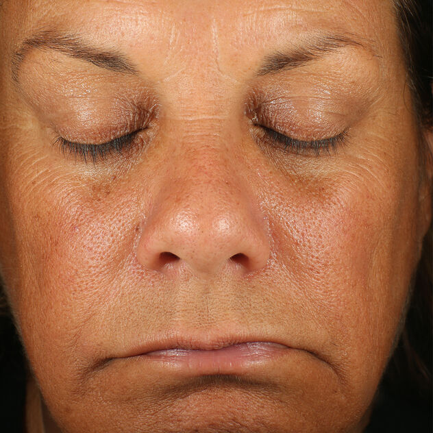 Retinol Skin Brightener 1 Percent  before-after-1